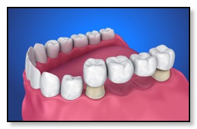dental bridge example diagram